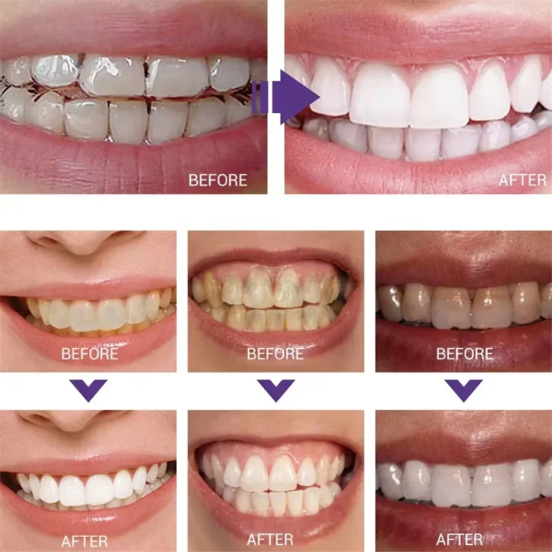 Teeth Cleansing Whitening Toot - Teeth Whitening Korea 评论和价格